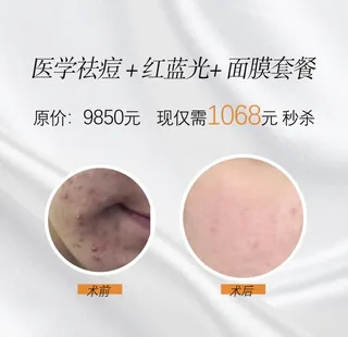 祛痘 去痘 去青春痘 祛青春痘图片