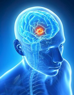 脑部肿瘤图片