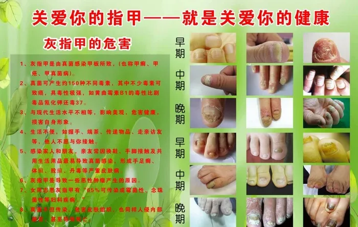 灰指甲的危害图片(4724x3150)psd模版下载