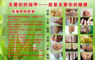 灰指甲的危害图片