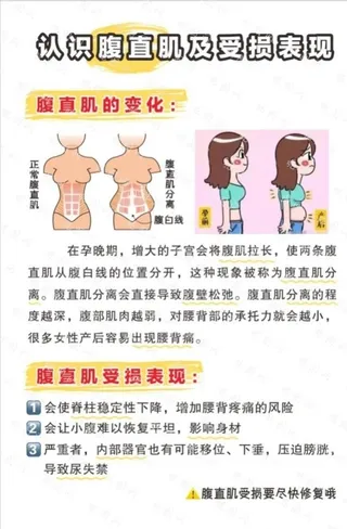 认识腹直肌及受损表现图片