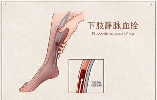 下肢静脉血栓图片