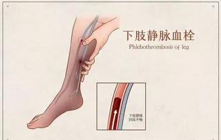 下肢静脉血栓图片