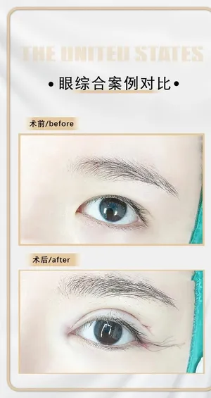 医美眼综合案例图片