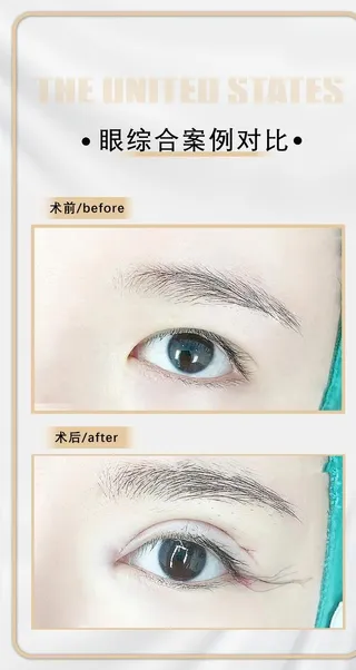 医美眼综合案例图片