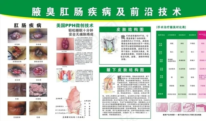 腋臭肛肠挂图图片cdr矢量模版下载