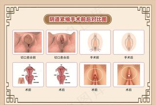 阴道紧缩术 术前术后对比图图片