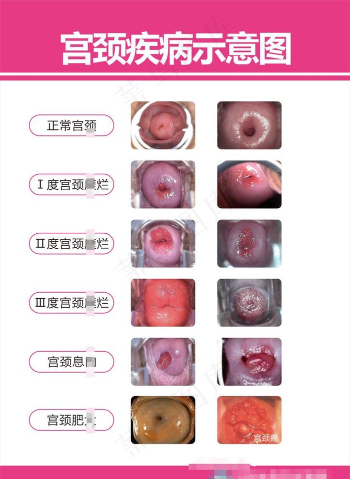 宫颈疾病示意图图片cdr矢量模版下载