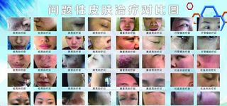 问题性皮肤治疗对比图美容院展板图片