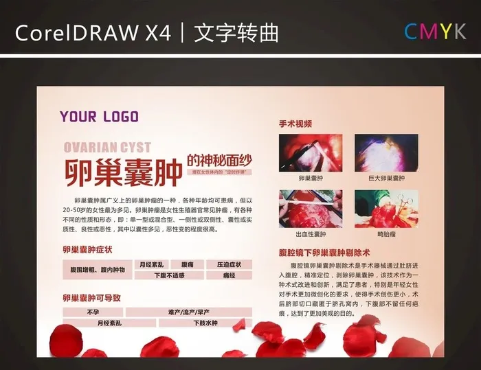 卵巢囊肿图片cdr矢量模版下载