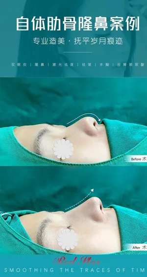医美隆鼻对比案例图片