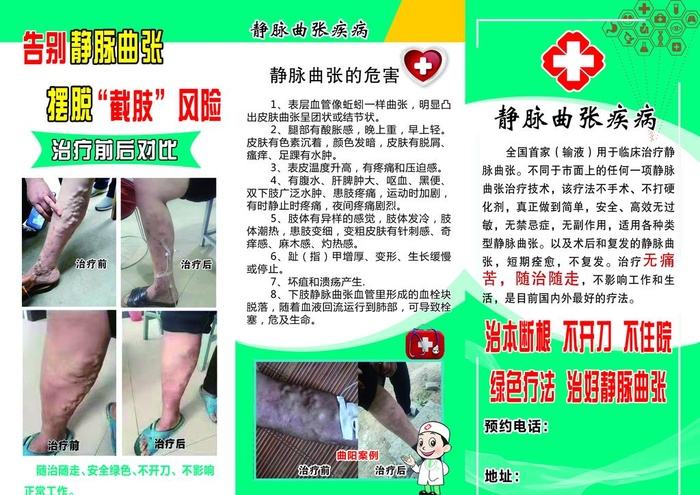 静脉曲张图片