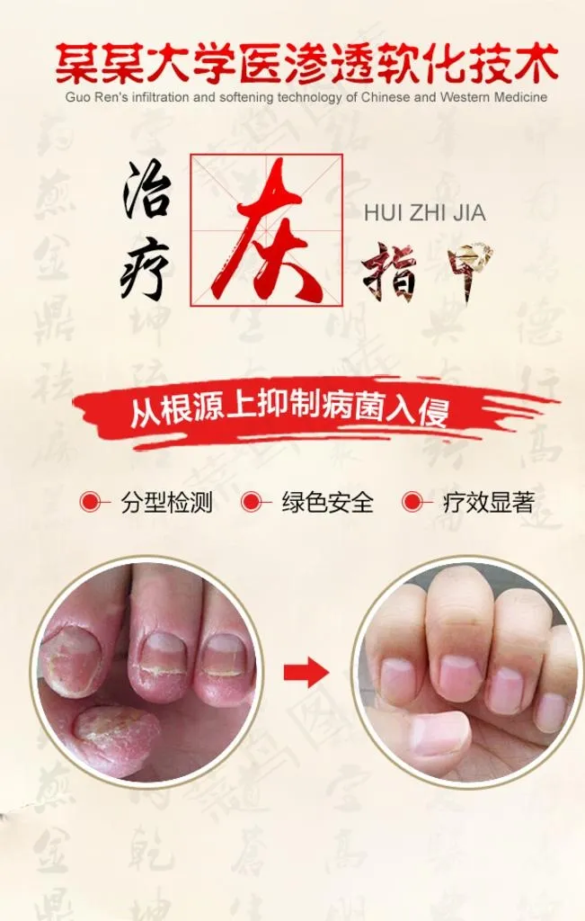 灰指甲图片psd模版下载