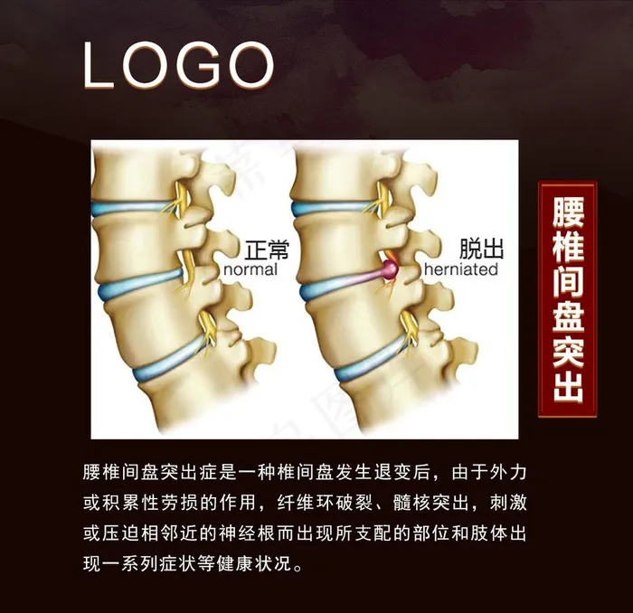 腰椎间盘突出图片(1616X1616(DPI:119))psd模版下载