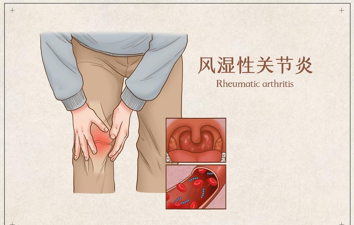 风湿性关节炎图片