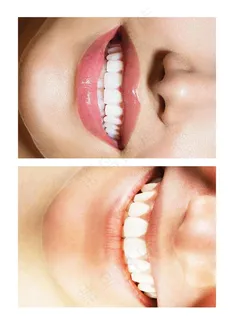 美牙图片 美牙图片