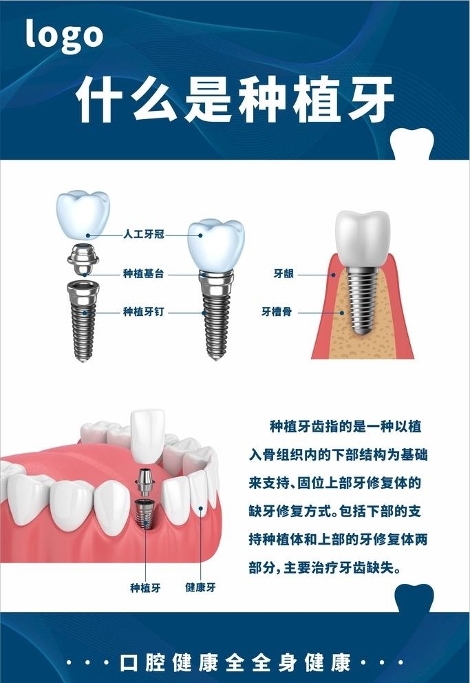 口腔医院种植科普展板-种植牙图片