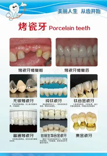 烤瓷牙图片 烤瓷牙图片