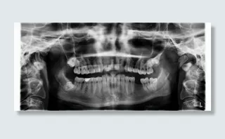 X射线，牙齿，牙齿缺失