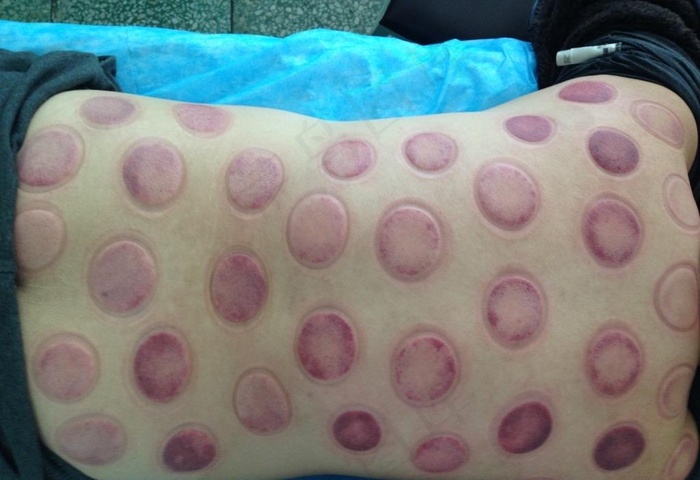 拔完罐子的后背图片