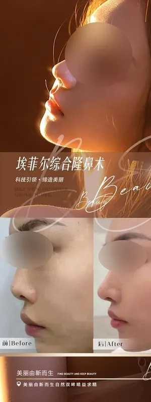 医美隆鼻案例对比海报图片