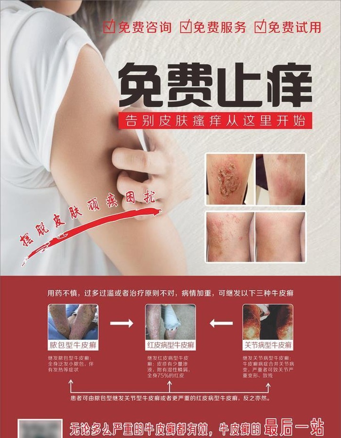 牛皮癣图片