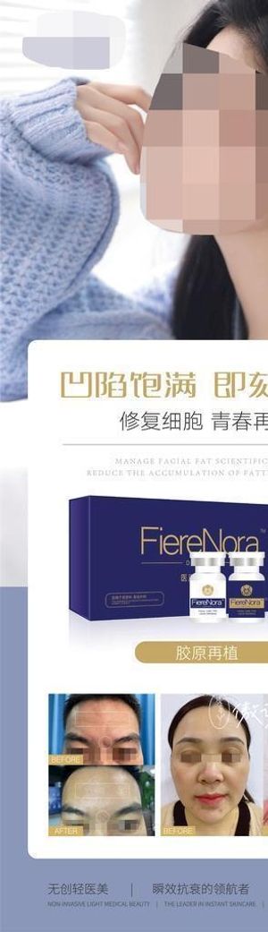 胶原再植 填充图片