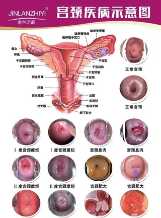 宫颈疾病图片