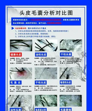 头皮毛囊分析对比图图片