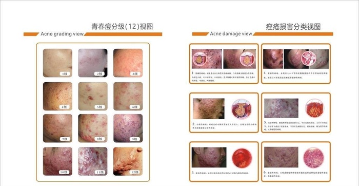 青春痘痤疮展板灯箱图片