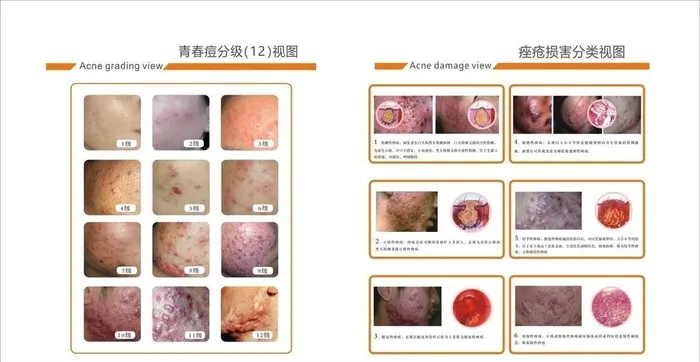 青春痘痤疮展板灯箱图片cdr矢量模版下载